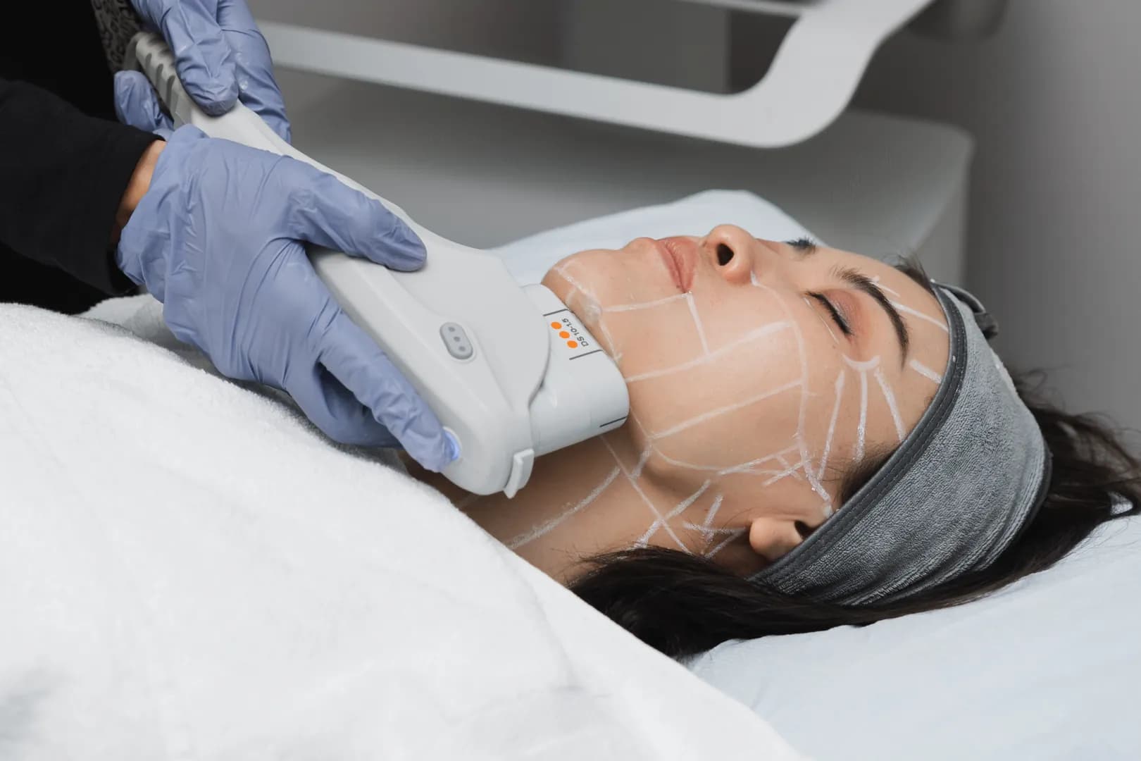 DPL Photo Facial treatment for skin rejuvenation