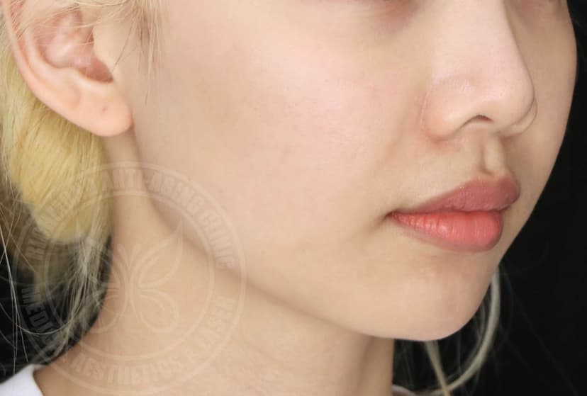 After Sylfirm X Treatment