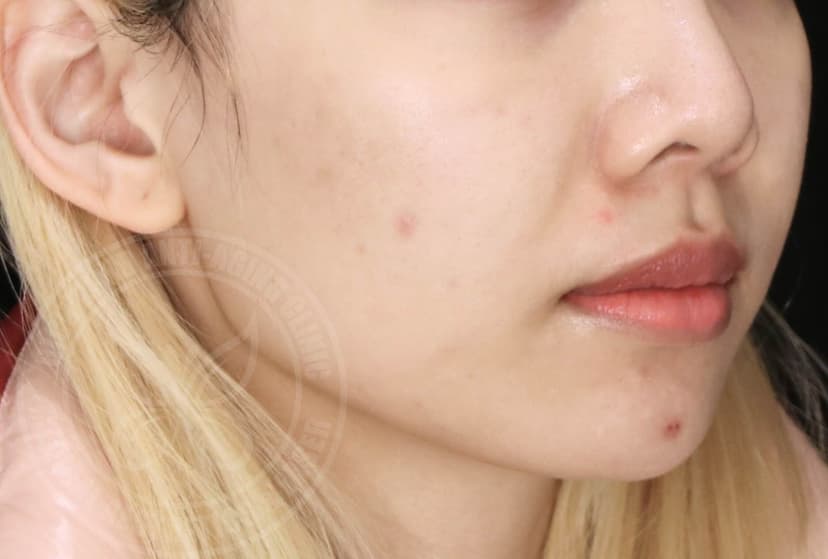 Before Sylfirm X Treatment