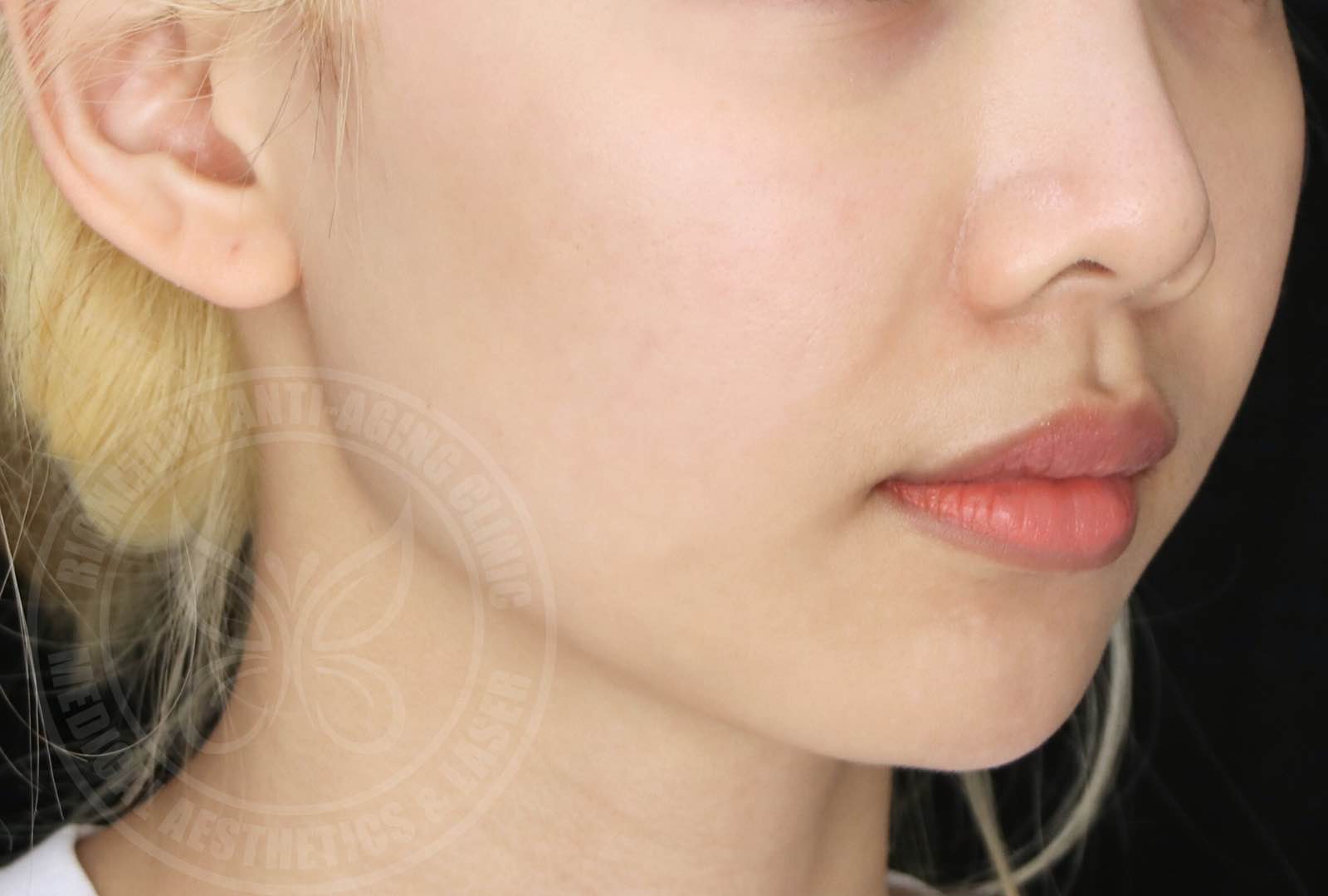 Sylfirm X® 射频微针 - 治疗后