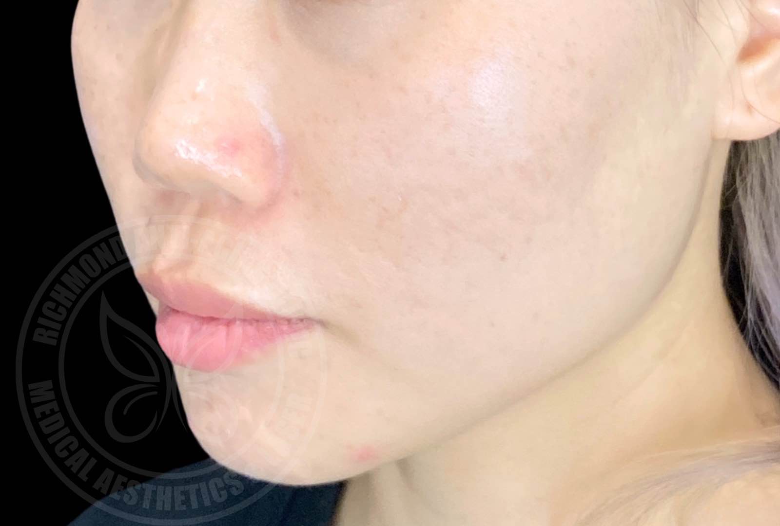 Thermage® FLX 热玛吉 - 治疗后