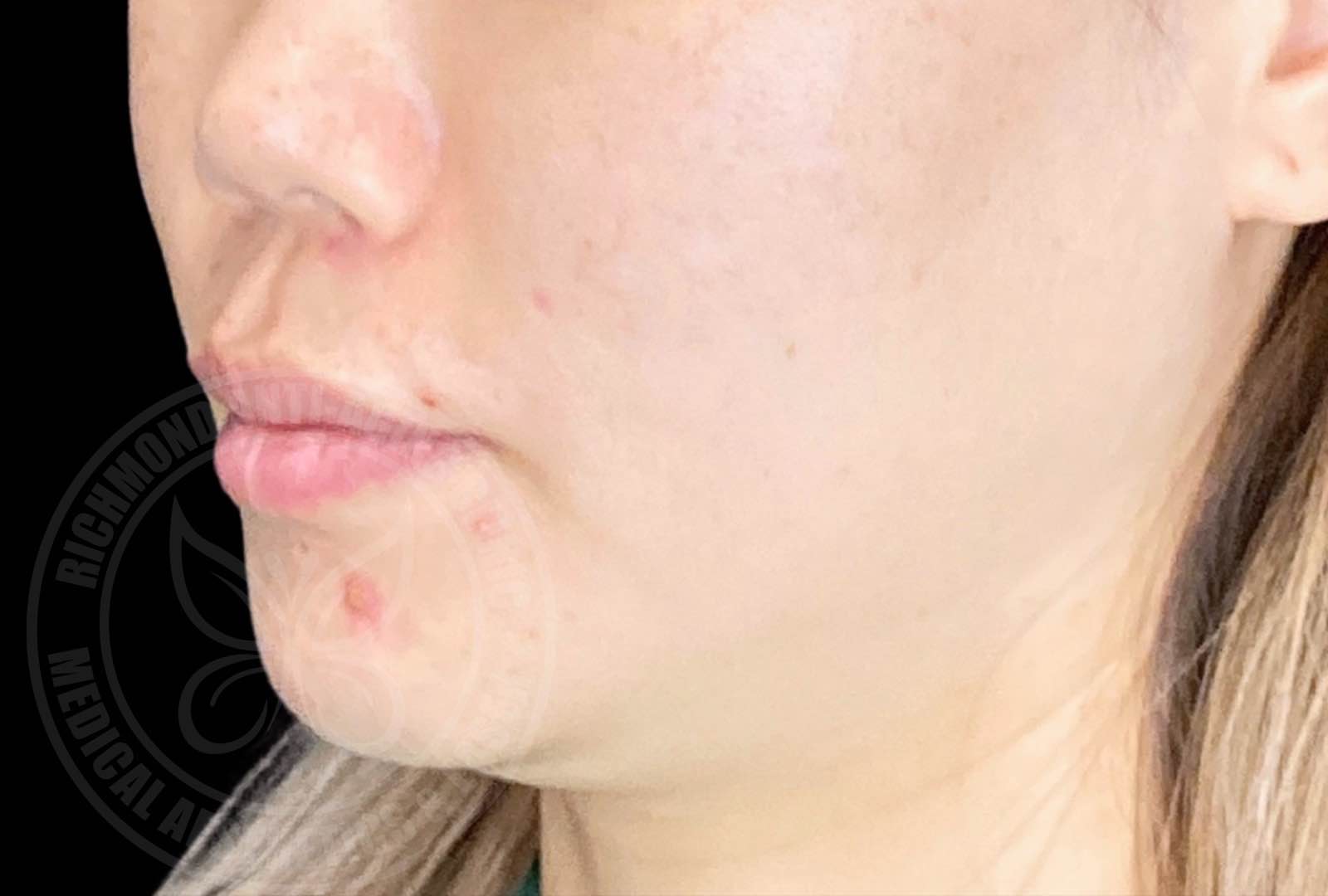 Thermage® FLX 热玛吉 - 治疗前