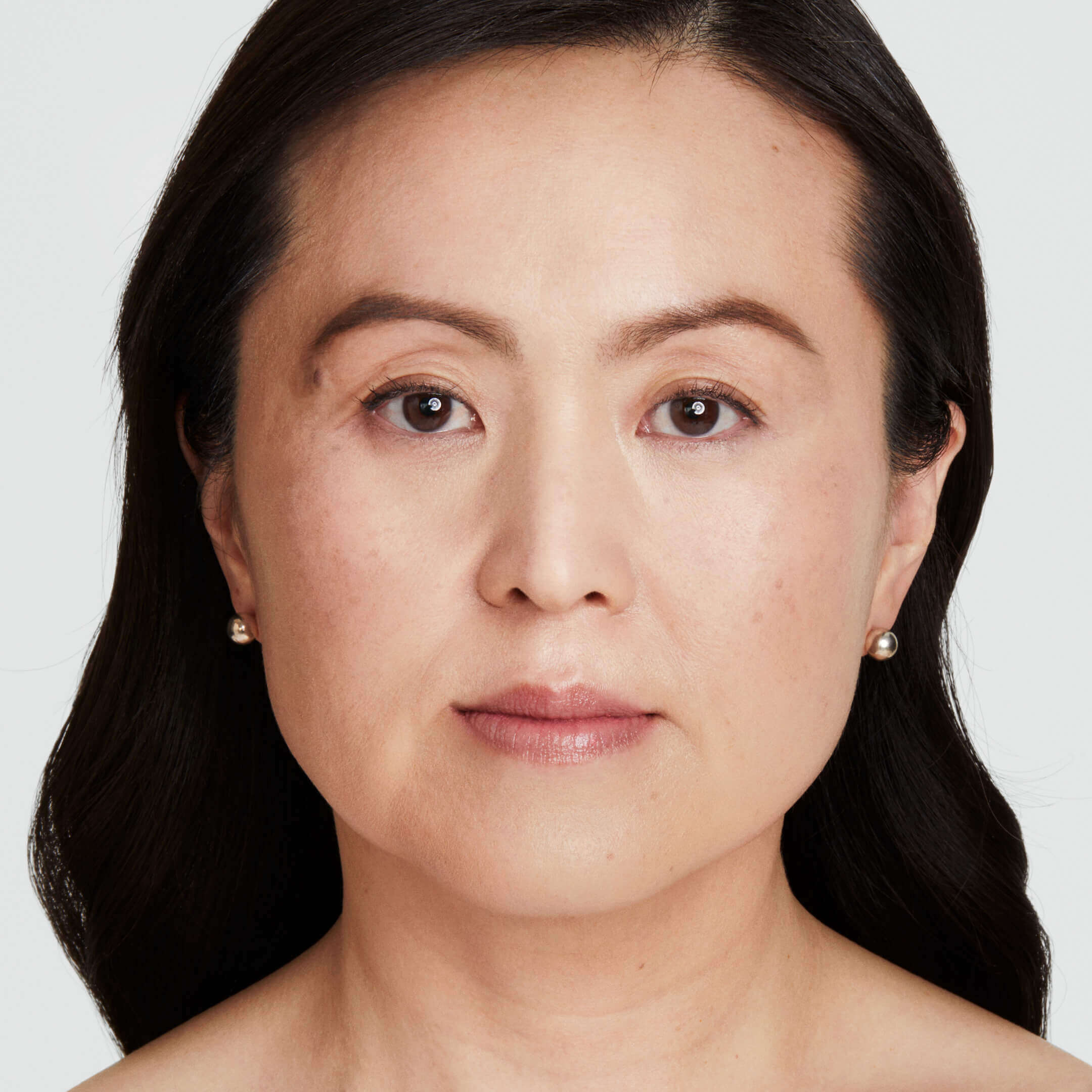 Ultherapy® 超声提升 - 治疗后