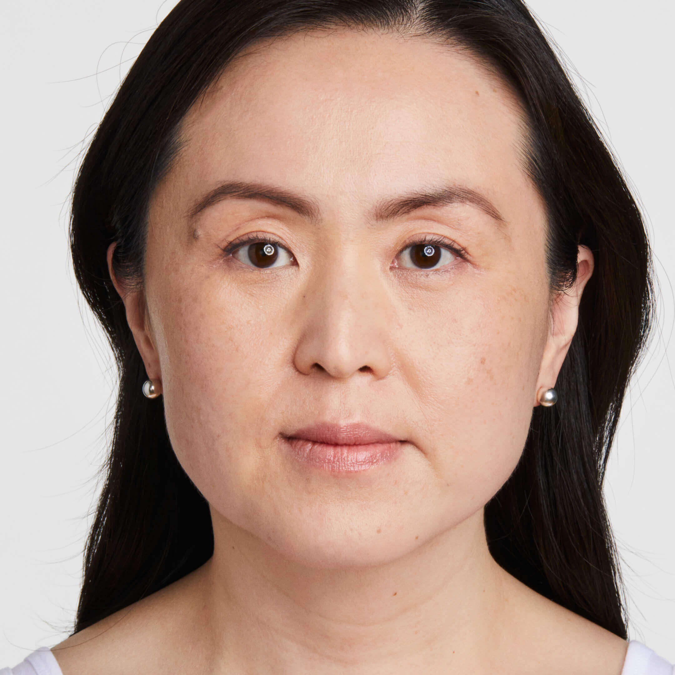 Ultherapy® 超声提升 - 治疗前